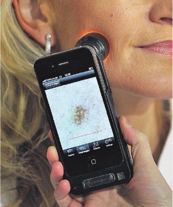 Met de smartphone zelf huidkanker opsporen